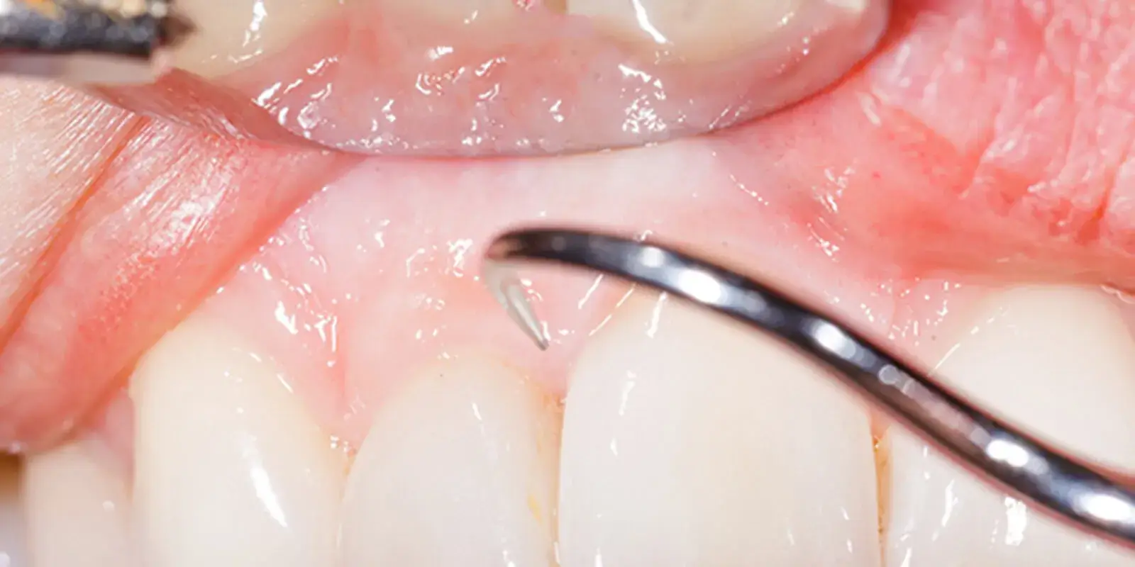 歯周病と全身疾患の関係性