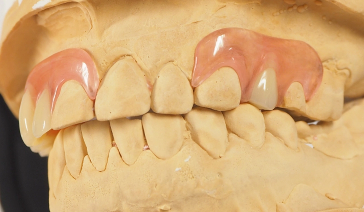 タムデンチャー(自由診療)
